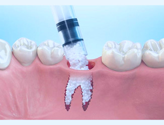 Bone Grafting - Parker Dental Group - Family Dentistry
